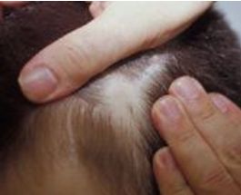 ALOPECIA TEMPORAL TRIANGULAR