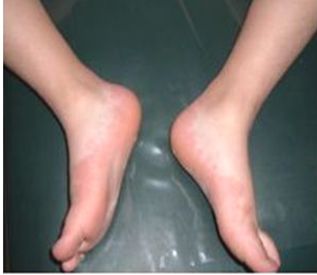 UN NIÑO CON UN EXANTEMA MUY PARTICULAR