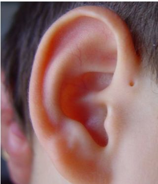 MAMELONES Y FOSITAS PREAURICLARES..