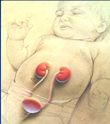 INFECCION URINARIA EN LA INFANCIA: CONSECUENCIAS A LARGO PLAZO 