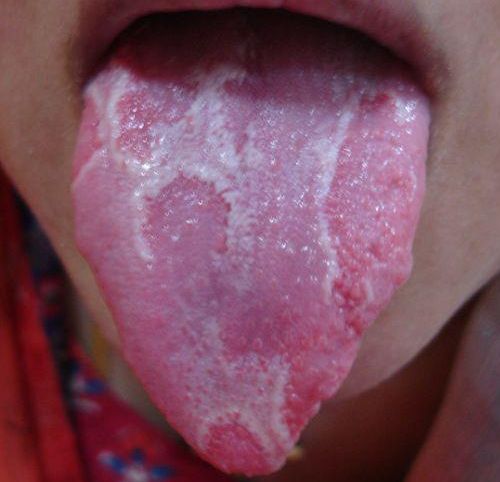 LENGUA GEOGRÁFICA, PLICATA  Y  OTRAS.