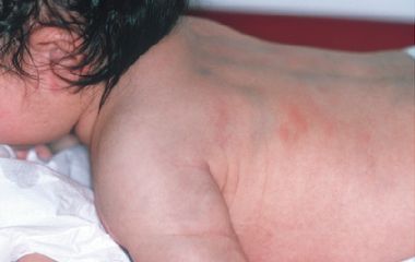 RN  CON LESION EN PIEL Y TCS