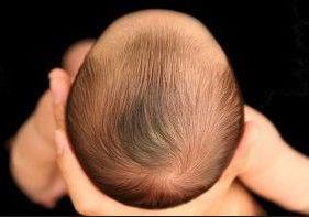 NIÑO CON DEPRESIONES EN SU CUERO CABELLUDO