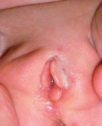 HIMEN EN PEDIATRIA: POLIPO  O TAG 