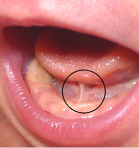 ANQUILOGLOSIA O FRENILLO LINGUAL CORTO