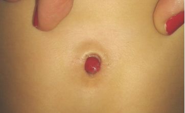 NÓDULO UMBILCAL PERSISTENTE EN UN NIÑO DE 6 MESES