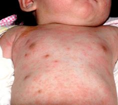 LACTANTE CON LESIONES NODULARES EN PIEL