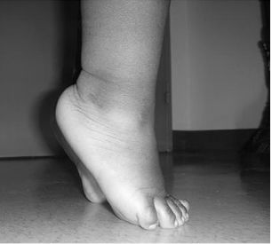 MARCHA EN PUNTA DE PIES IDIOPATICA.