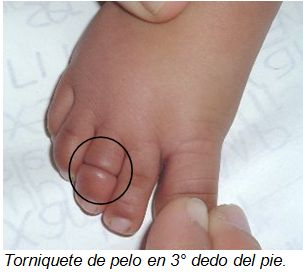 SÍNDROME DEL TORNIQUETE DE PELO