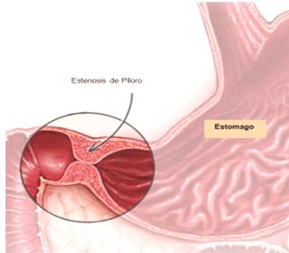 USO DE MACRÓLIDOS Y RIESGO DE ESTENOSIS HIPERTRÓFICA DE  PÍLORO