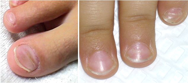 ALTERACIONES UNGUEALES EN NIÑOS