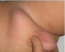 TESTICULO NO DESCENDIDO –  ACTUALIZACIÓN