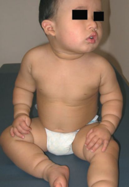 LACTANTE DE 4 MESES CON BANDAS EN LA PIEL