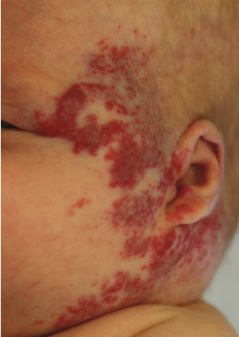 HEMANGIOMA SEGMENTARIO DE CARA