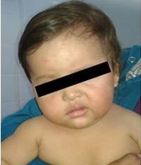 TORTICOLIS EN NIÑOS