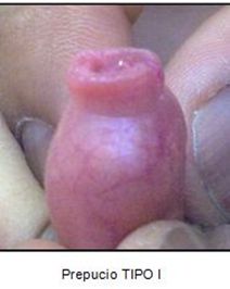 CUIDADO DEL PREPUCIO  