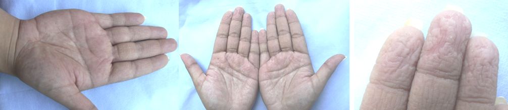 ARRUGAS ACUAGÉNICA DE LAS PALMAS  O QUERATODERMIA PALMO-PLANTAR ACUAGÉNICA,Y FIBROSIS QUISTICA