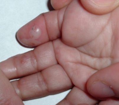 LESION EN DEDO - HAGA SU DIAGNOSTICO