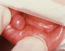 QUISTE DE RETENCIÓN MUCOSA: MUCOCELE 