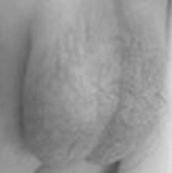 VELLO PÚBICO O ESCROTAL EN MENORES DE 1 AÑO.