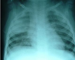 NEUMONIA ADQUIRIDA EN LA COMUNIDAD: