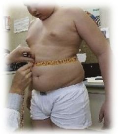 OBESIDAD INFANTIL