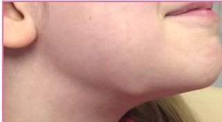 ADENOMEGALIAS EN NIÑOS