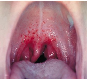TRATAMIENTO DE FARINGITIS ESTREPTOCOCCICA EVALUACIÓN DE 3 TRATAMIENTOS DIFERENTES.