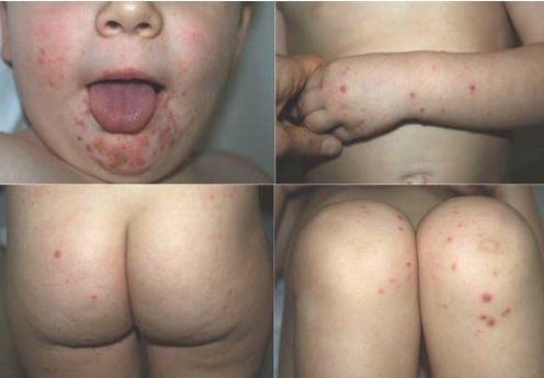 “ECZEMA COXSACKIUM”