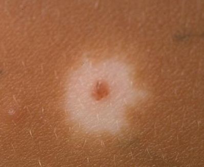 HALO DESPIGMENTADO ALREDEDOR DE UN NEVUS.